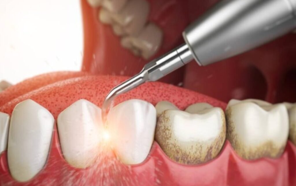 Teeth Whitening Treatment at Hariharan detal care image