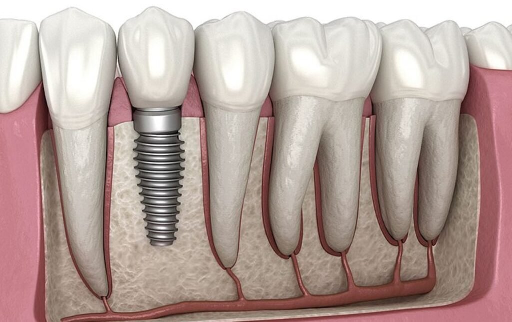 Dental Implant at hariharan dental care image
