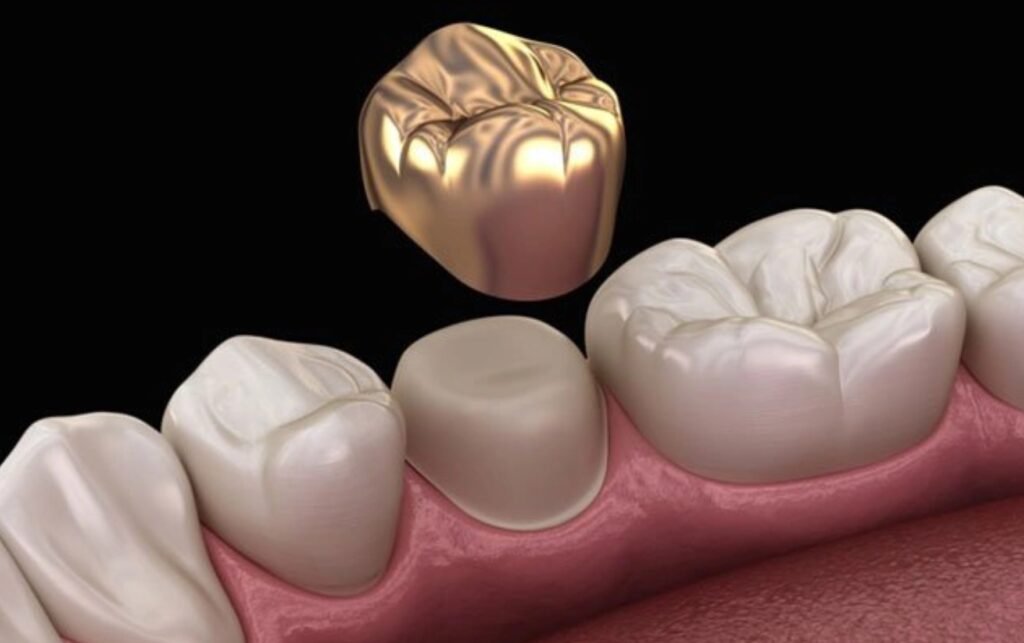 Dental Crowns & Bridges Image