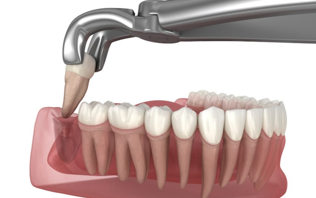 Wisdom Tooth Extraction Treatment in Hariharan Dental Care Image